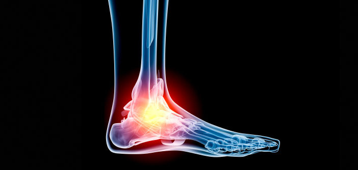 The Uniqueness of Syndesmotic (high) Ankle Sprains - Zamst Blog