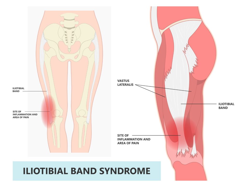 A diagram of IT band syndrome and where the pain occurs
